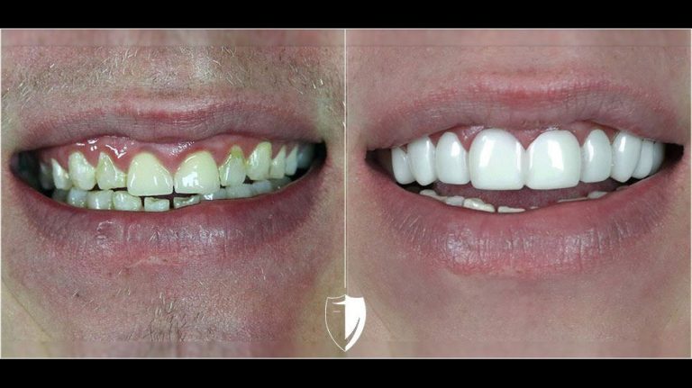 BilVeneers client Justin V before and after